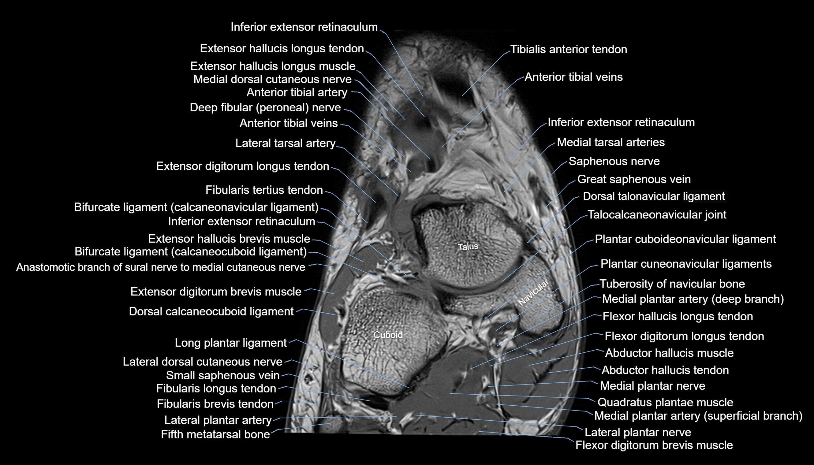 Ankle coronal anatomy 3T MRI images -img-11001-00002.webp